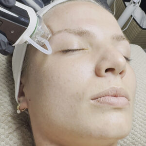 Microneedling carousel_0001_Image1