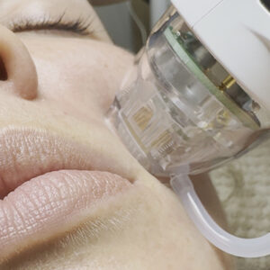 Microneedling carousel_0003_Image1